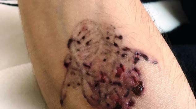 Hayalleri için sildirmek istediği dövmeler kabusu oldu