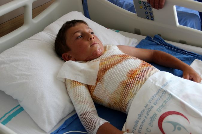 Gömleğindeki ipi yakmak isterken kendini yaktı