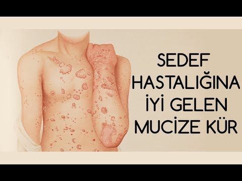 SEDEF HASTALIĞINA İYİ GELEN BİTKİLER