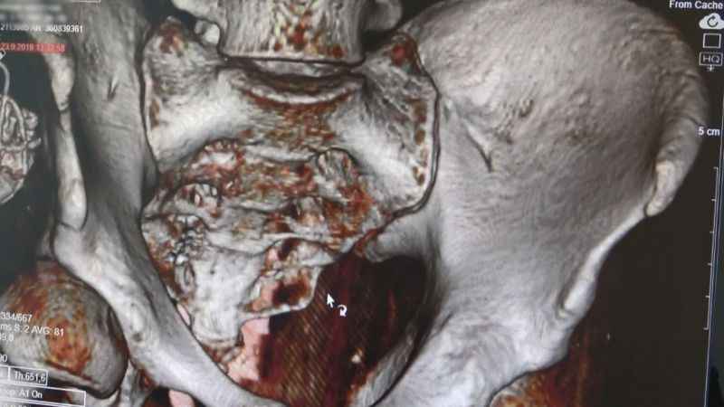 Hayatı kolaylaştıran tedavi: ‘Mesane pili'