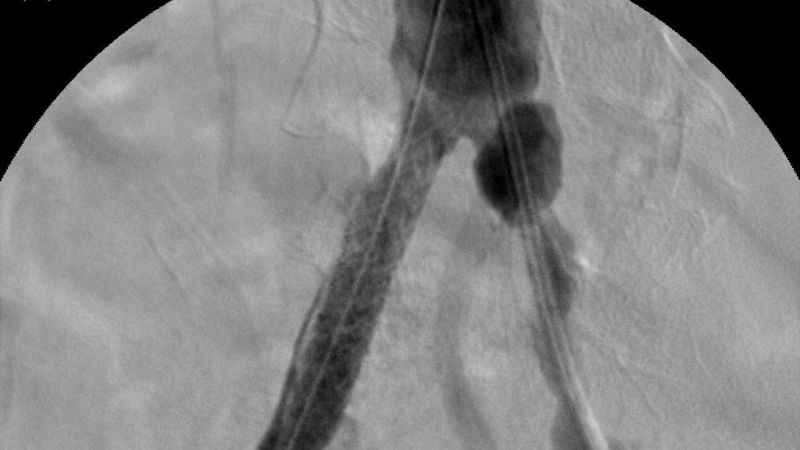 Türkiye’nin ilk yerli stent grefti başarıyla hastalara uygulandı