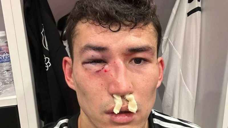 Beşiktaş: "Zaynutdinov'un burnunda ve göz çukurunda kırık saptanmıştır"
