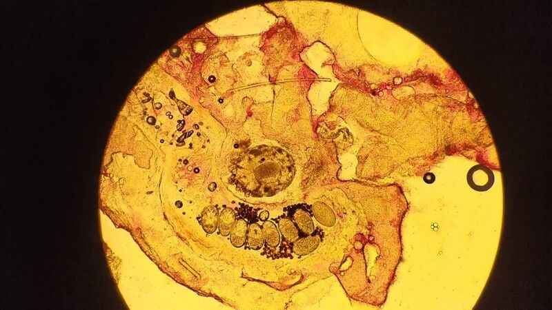 Banyo sonrası şiddetli kaşıntı uyuz işareti olabilir