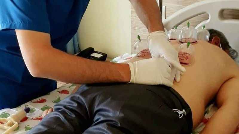 Hacamatta yanlış uygulama geçmeyen ağrılara sebep oluyor Hacamatta yanlış uygulama geçmeyen ağrılara sebep oluyor