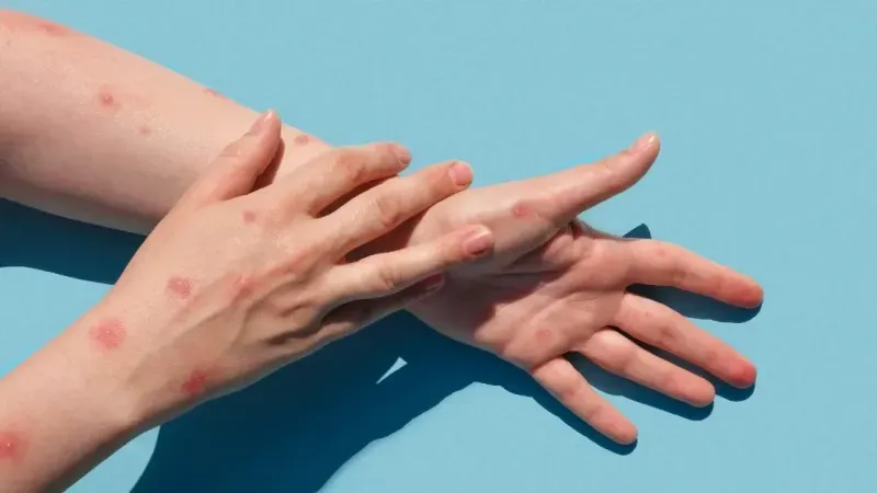 Maymun çiçeği hakkında uzmanından açıklama: Ateş, baş ağrısı ve halsizlik ile başlar Maymun çiçeği hakkında uzmanından açıklama: Ateş, baş ağrısı ve halsizlik ile başlar