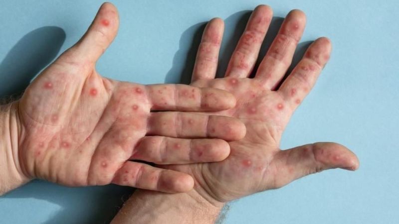 İstanbul İl Sağlık Müdürlüğü’nden "İstanbul’da maymun çiçeği görüldü" iddialarına ilişkin açıklama İstanbul İl Sağlık Müdürlüğü’nden "İstanbul’da maymun çiçeği görüldü" iddialarına ilişkin açıklama