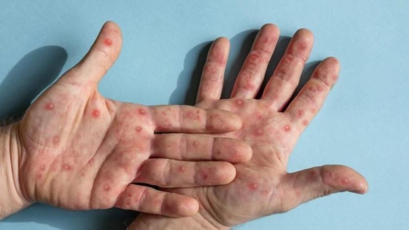 İstanbul İl Sağlık Müdürlüğü’nden "İstanbul’da maymun çiçeği görüldü" iddialarına ilişkin açıklama İstanbul İl Sağlık Müdürlüğü’nden "İstanbul’da maymun çiçeği görüldü" iddialarına ilişkin açıklama