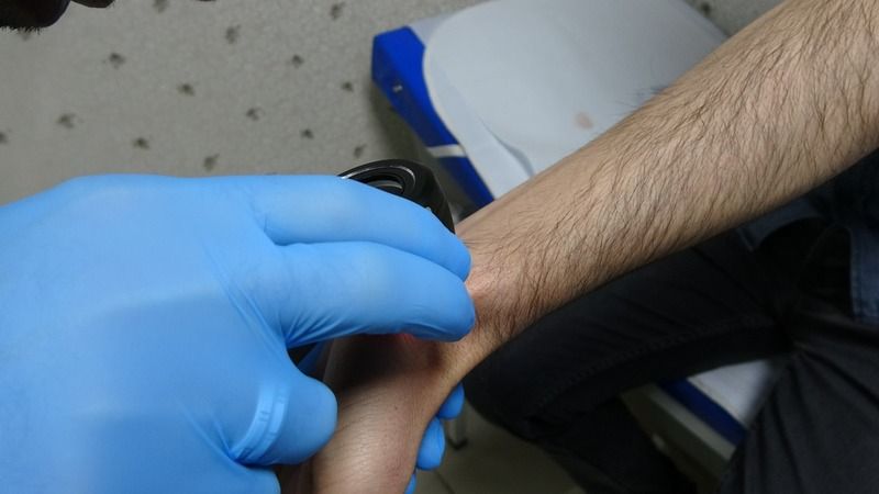 Uyuz hastalığı covid-19 ile tetiklendi