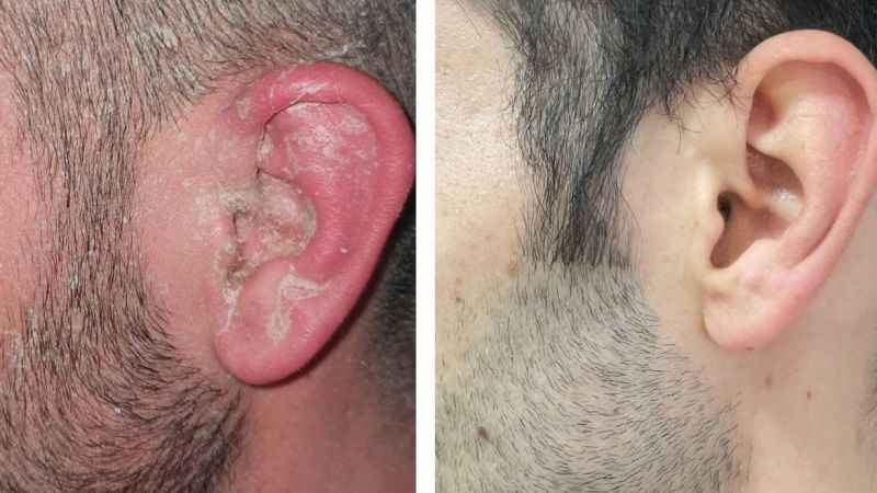 Sedef hastalığının tedavisi kolay