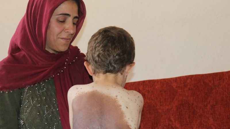 Vücudunu saran dev benlerden kurtulmak istiyor Vücudunu saran dev benlerden kurtulmak istiyor