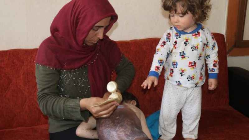 Vücudunu saran dev benlerden kurtulmak istiyor Vücudunu saran dev benlerden kurtulmak istiyor
