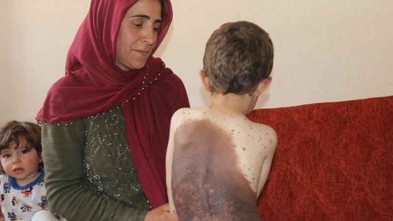 Vücudunu saran dev benlerden kurtulmak istiyor