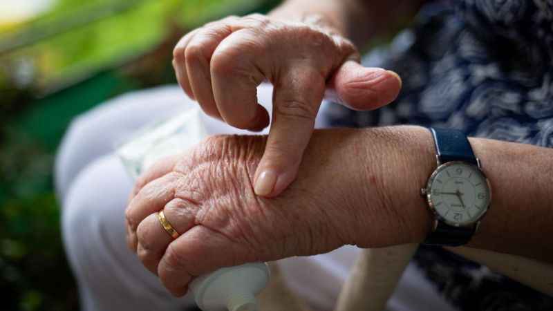 Güneşle gelen cilt lekelerine dikkat