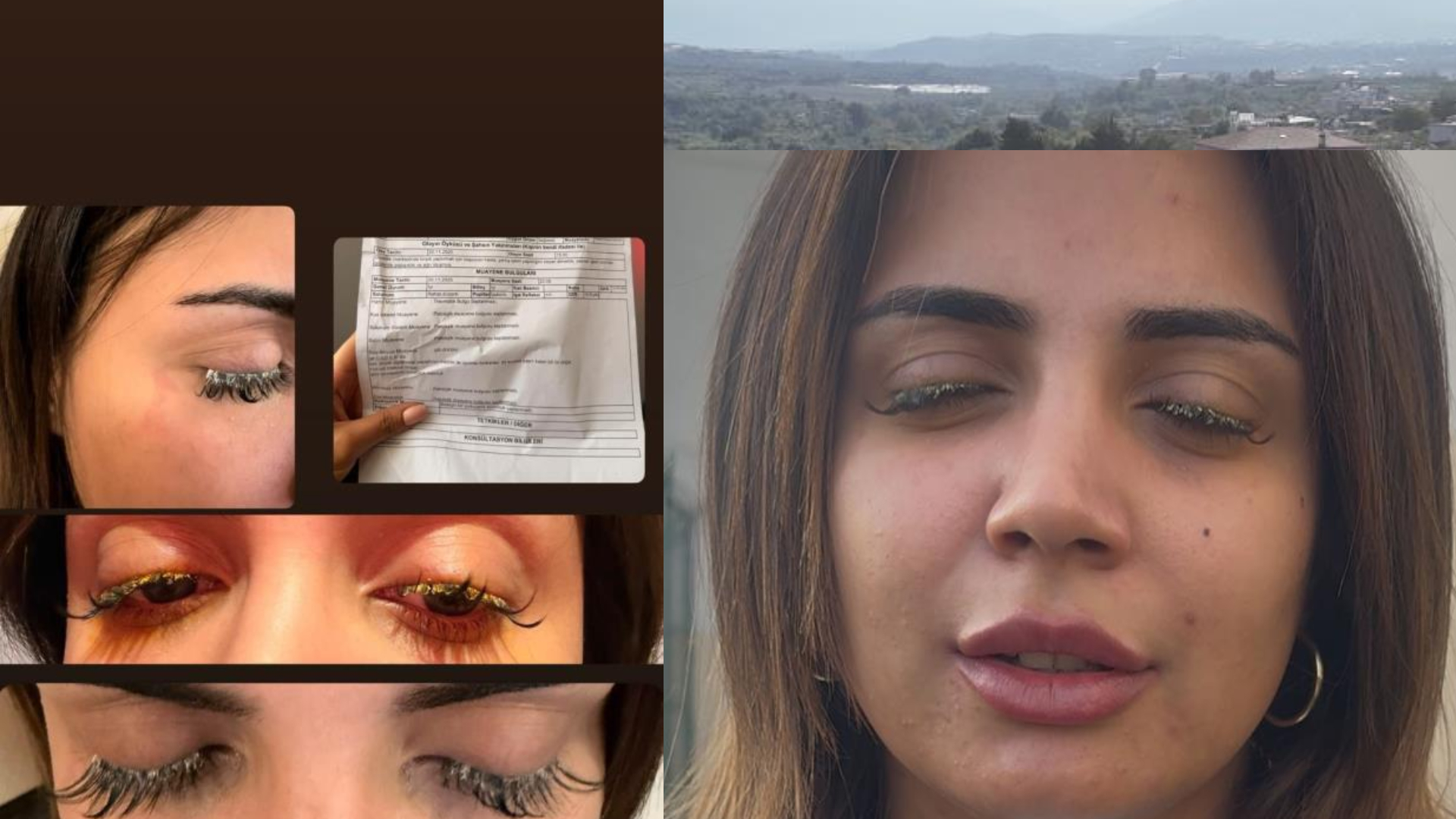 Güzellik merkezinde gözünü kaybediyordu