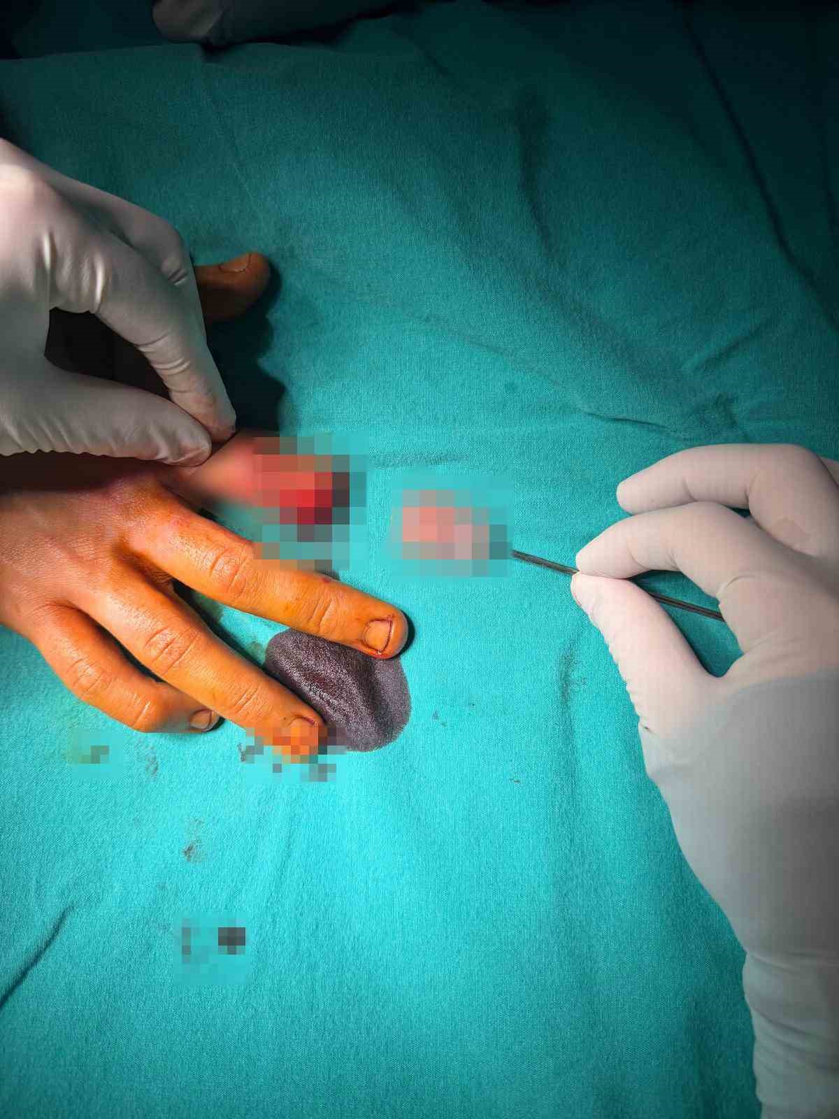 Bandırma’da asansör kazasında kopan parmak başarılı ameliyatla kurtarıldı
