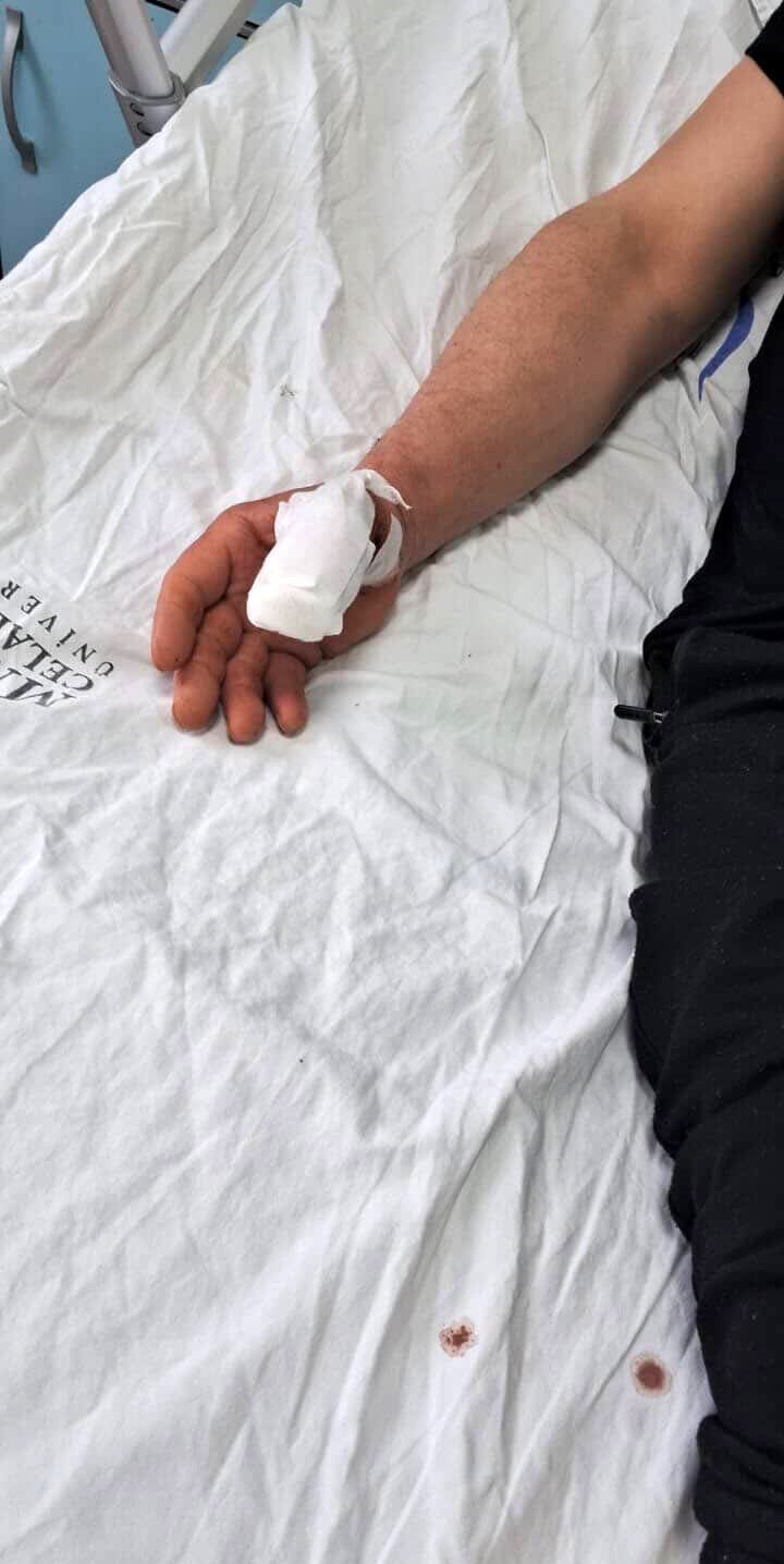 Başıboş köpeklerin saldırısına uğrayan adamın baş parmağı koptu
