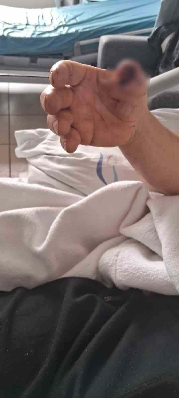 Başıboş köpeklerin saldırısına uğrayan adamın baş parmağı koptu
