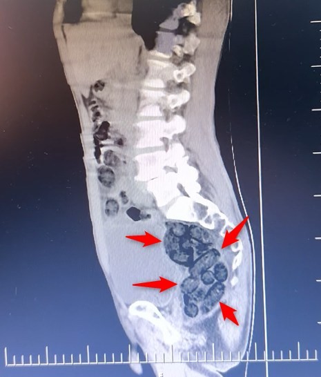 Batman’da yabancı uyruklu bir  şahsın midesinden 64 parça uyuşturucu çıktı
