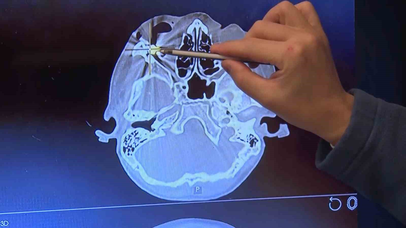 Beynine mermi saplanan çocuk hasta Memorial’daki "nöronavigasyon" teknolojili operasyonla sağlığına kavuştu
Beynine mermi saplanan çocuk hasta Memorial’daki "nöronavigasyon" teknolojili operasyonla sağlığına kavuştu