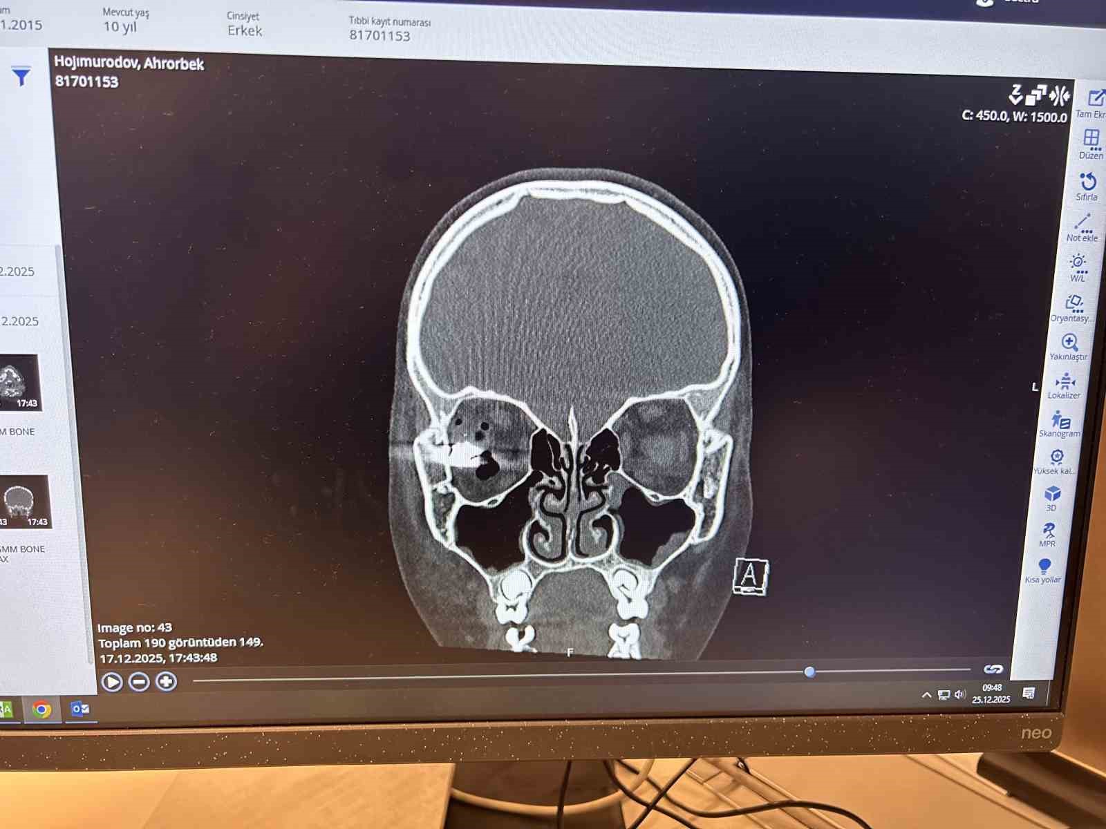 Beynine mermi saplanan çocuk hasta Memorial’daki "nöronavigasyon" teknolojili operasyonla sağlığına kavuştu
Beynine mermi saplanan çocuk hasta Memorial’daki "nöronavigasyon" teknolojili operasyonla sağlığına kavuştu