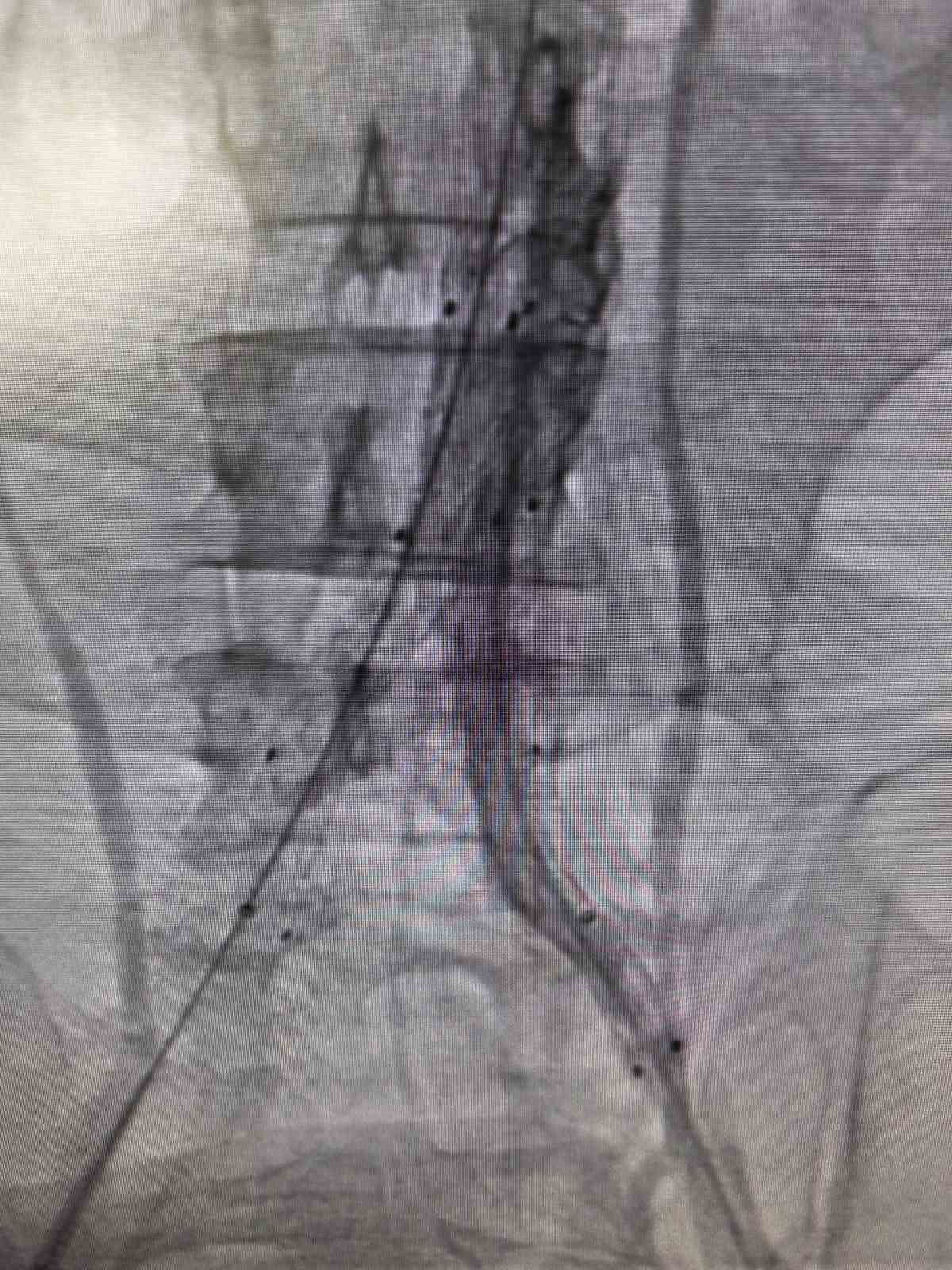 Bilecik’te hayat kurtaran kapalı damar operasyonu
Bilecik’te hayat kurtaran kapalı damar operasyonu