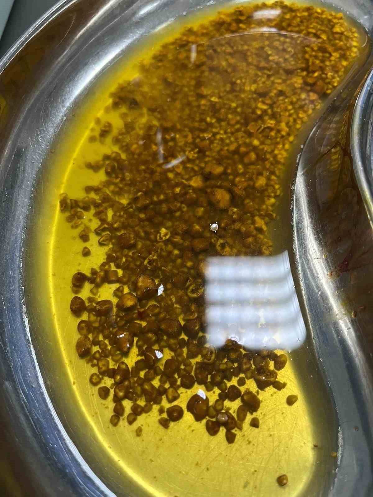 Bingöl’de nadir vaka: Safra kesesinden 2 bin 67 taş çıkarıldı
