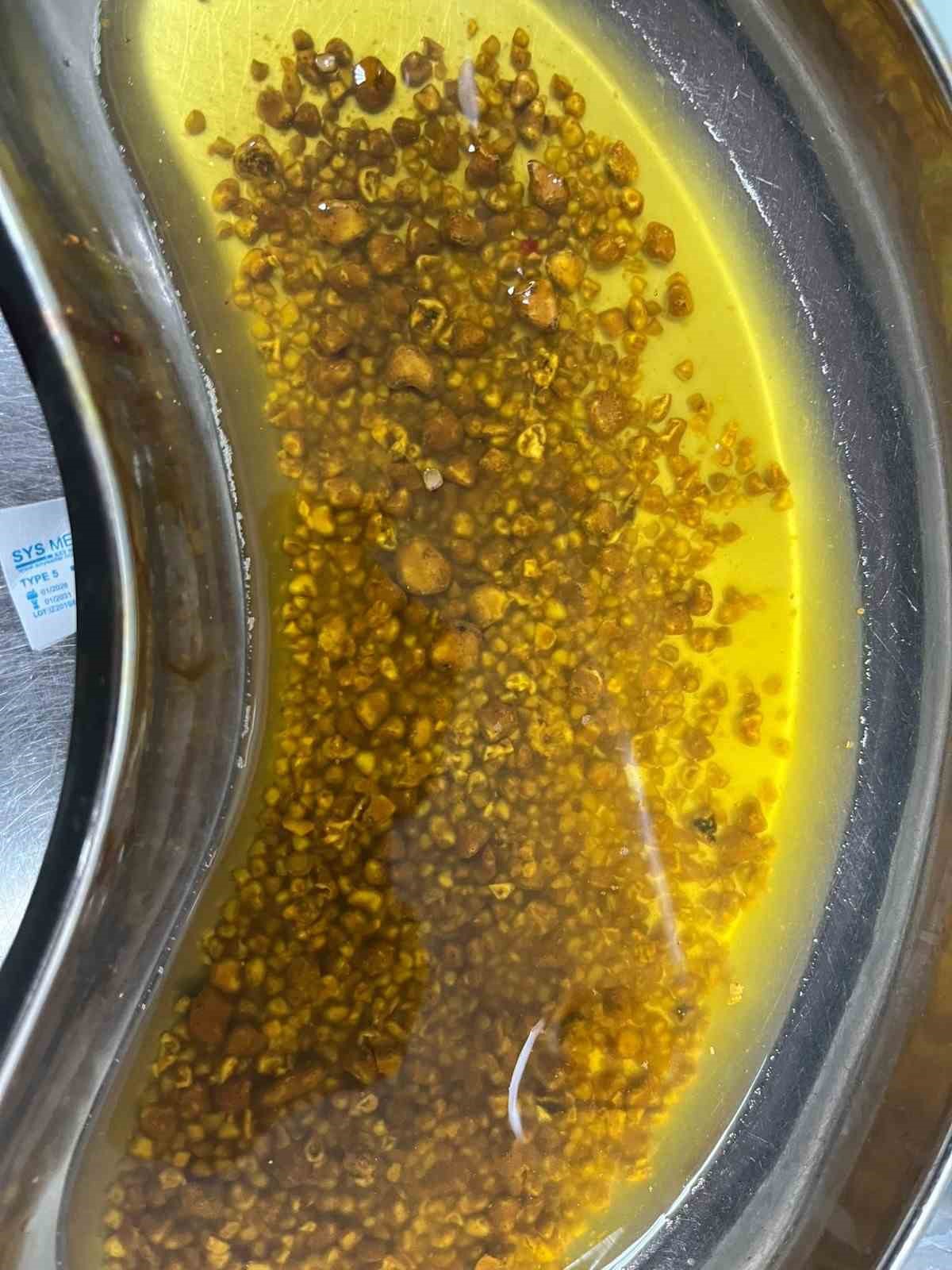 Bingöl’de nadir vaka: Safra kesesinden 2 bin 67 taş çıkarıldı
