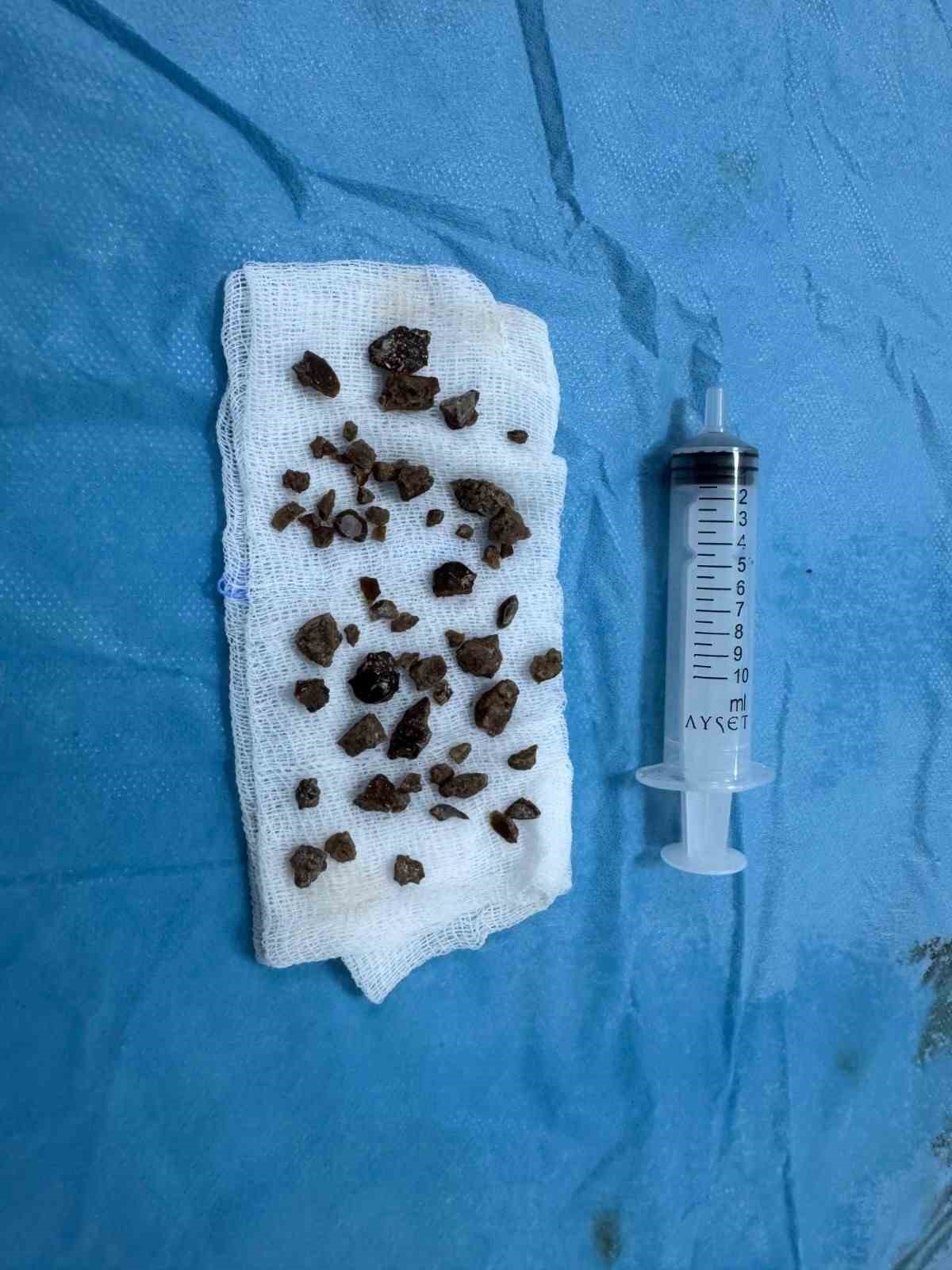 Bingöl’de PNL yöntemiyle böbrek taşı tedavisinde sevkler azaldı
