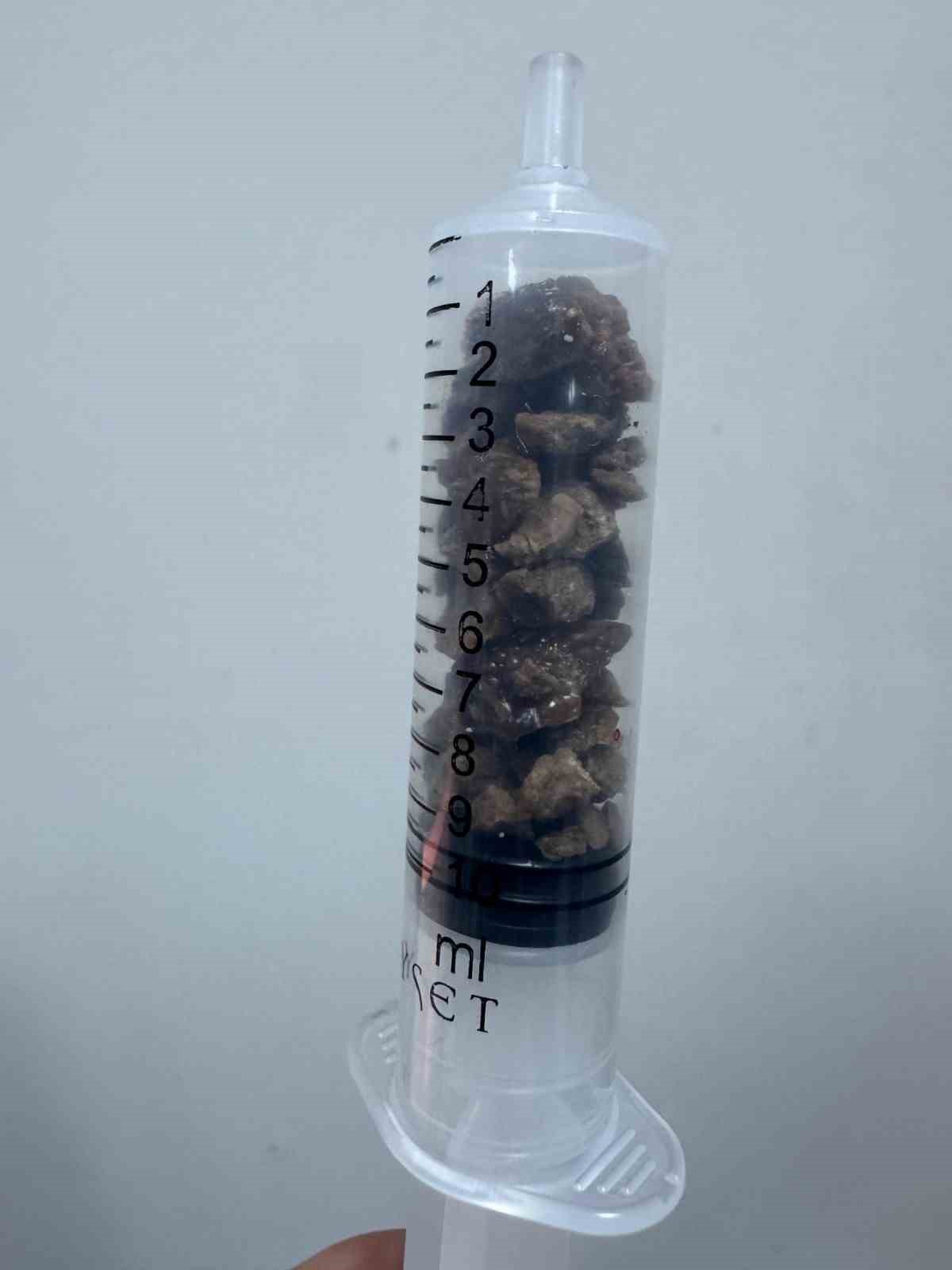 Bingöl’de PNL yöntemiyle böbrek taşı tedavisinde sevkler azaldı
