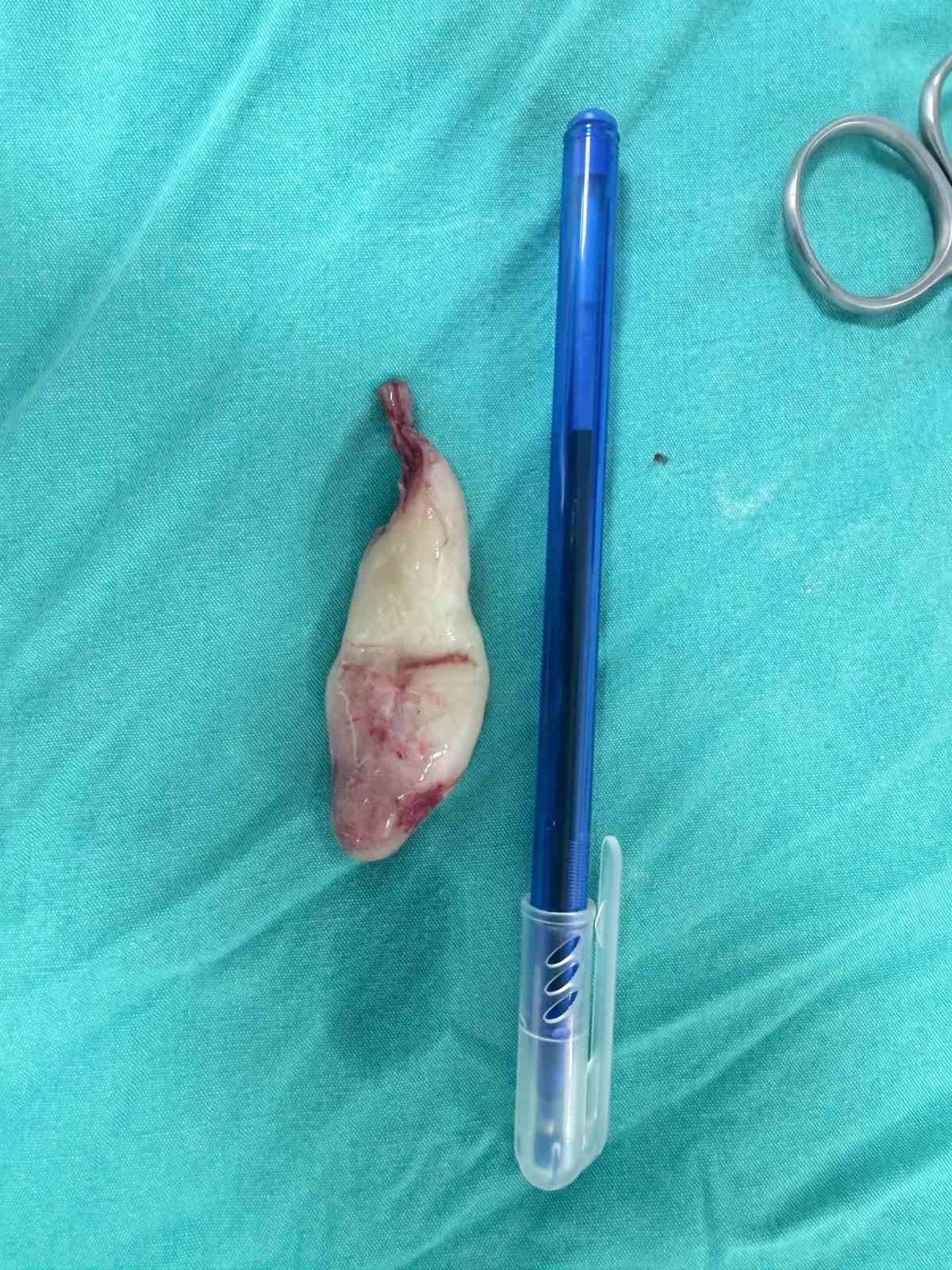 Burun tıkanıklığı ve işitme kaybı şikayetiyle gitti, ameliyatta dev bir polip çıkartıldı
