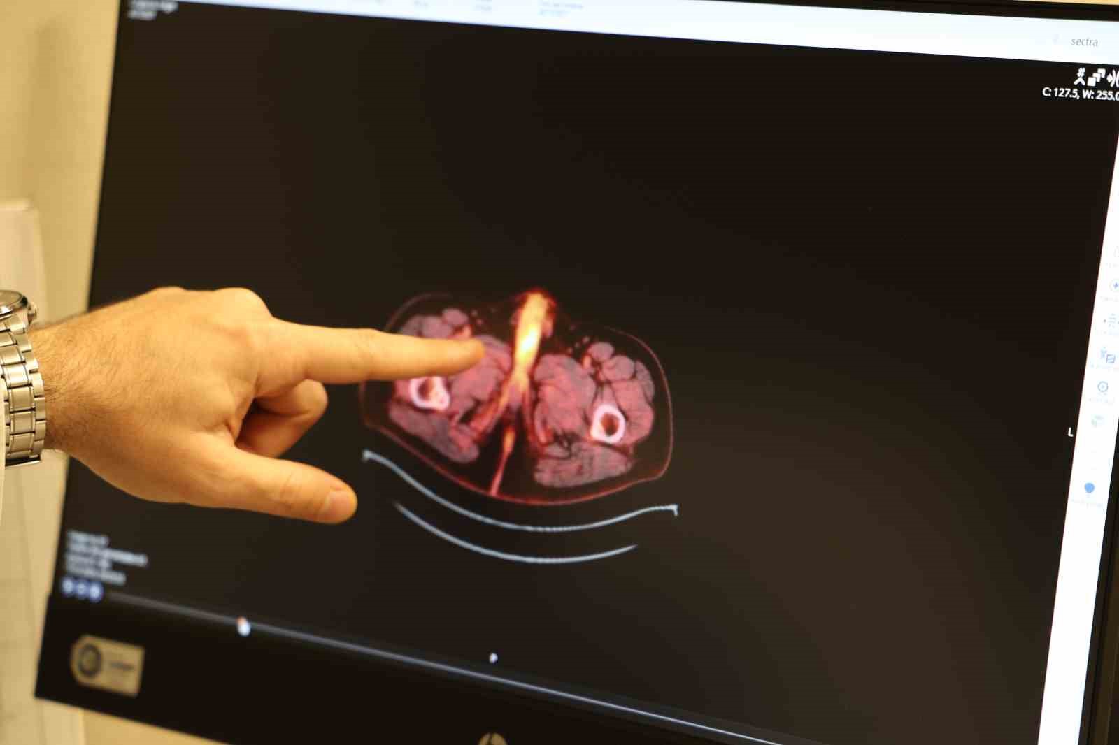 Dünyada şu ana kadar 60 kişide olan bu vakanın sonuncusu Diyarbakır’da görüldü
Dünyada şu ana kadar 60 kişide olan bu vakanın sonuncusu Diyarbakır’da görüldü