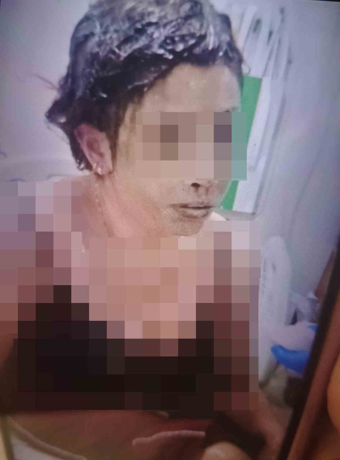 Gaziantep’te vahşet: Eski eşini kezzapla ağır yaraladı
