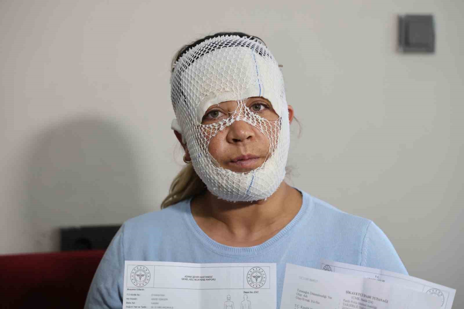 Güzelleşmek uğruna gittiği merkezde yüzü yandı
