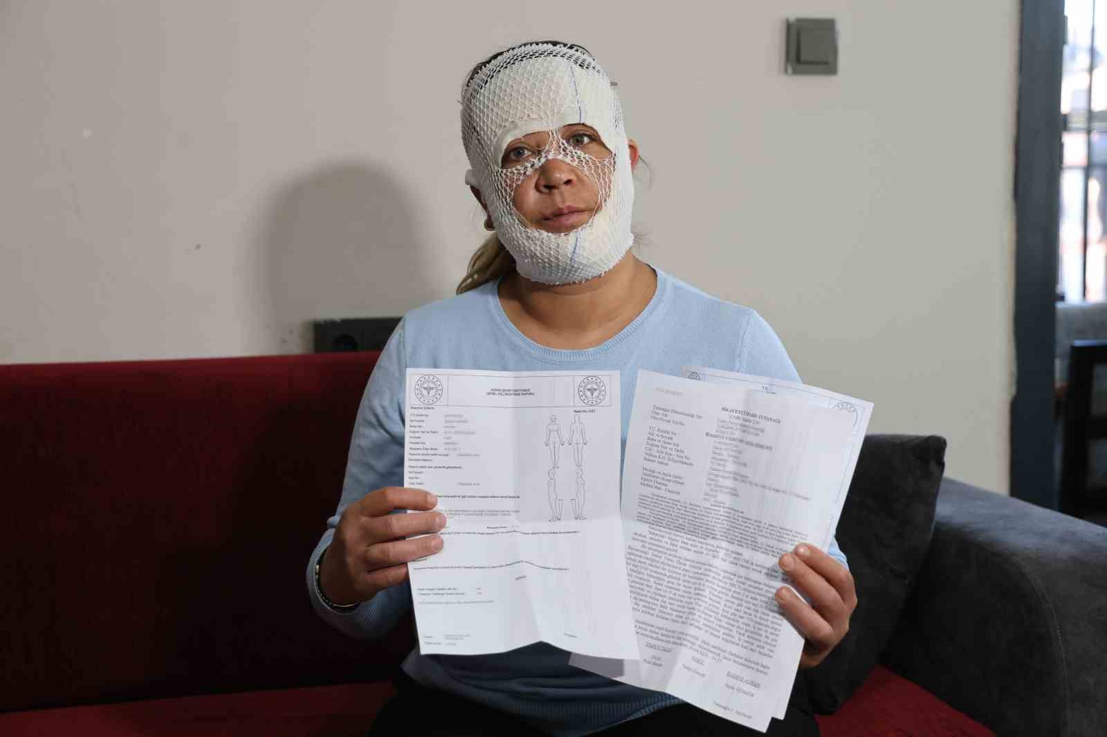 Güzelleşmek uğruna gittiği merkezde yüzü yandı
