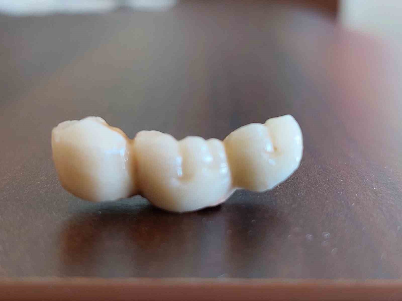 İmplant elinde hasta şikayette
