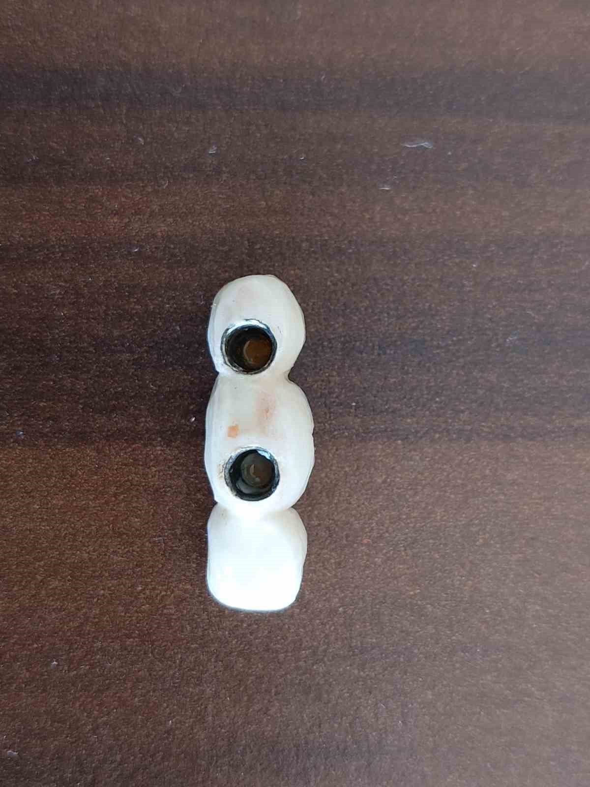 İmplant elinde hasta şikayette
