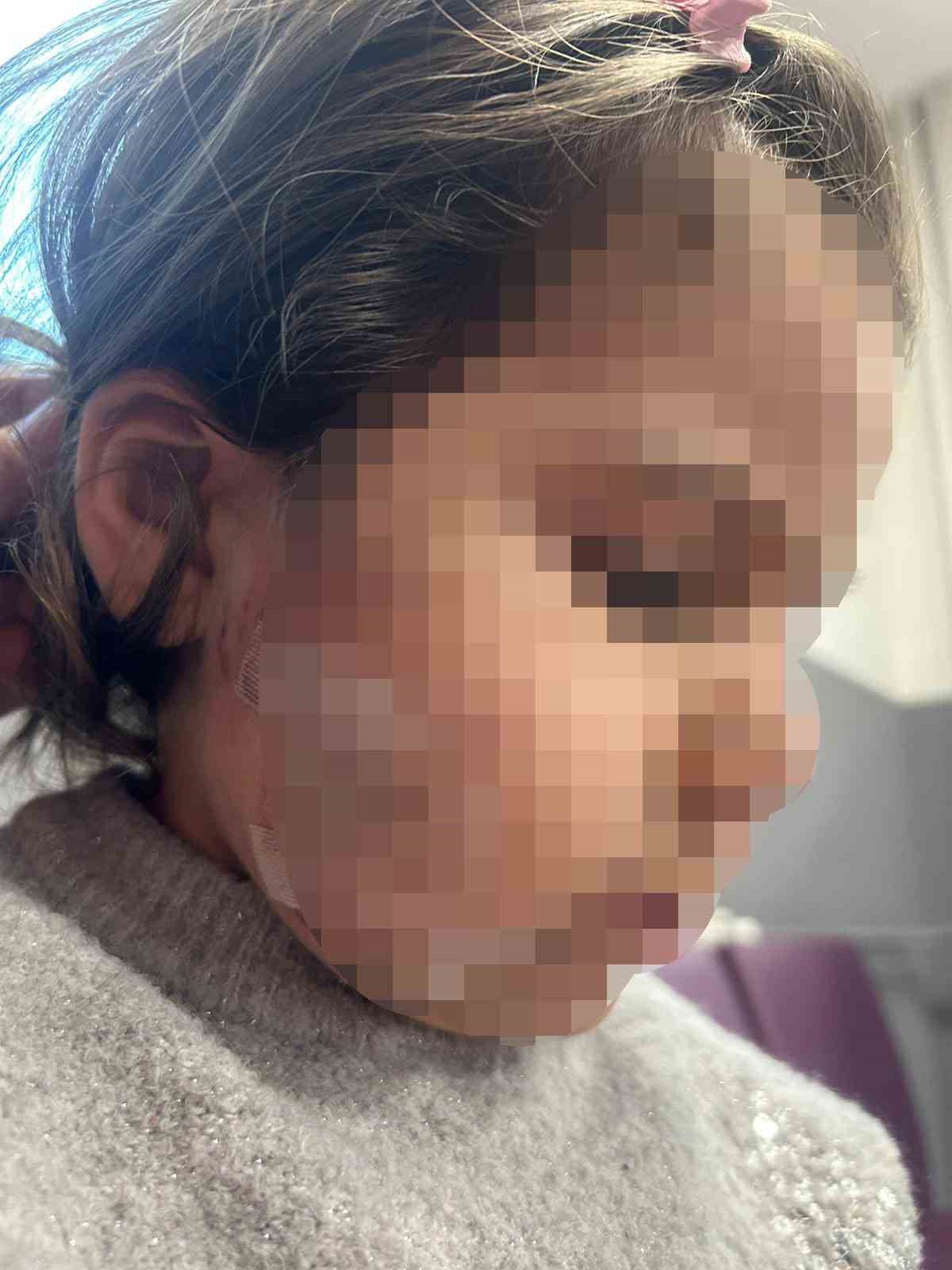 İzmir’de köpek dehşeti: 3 yaşındaki Ada’nın yüzü pençe ve ısırıkla dolu
