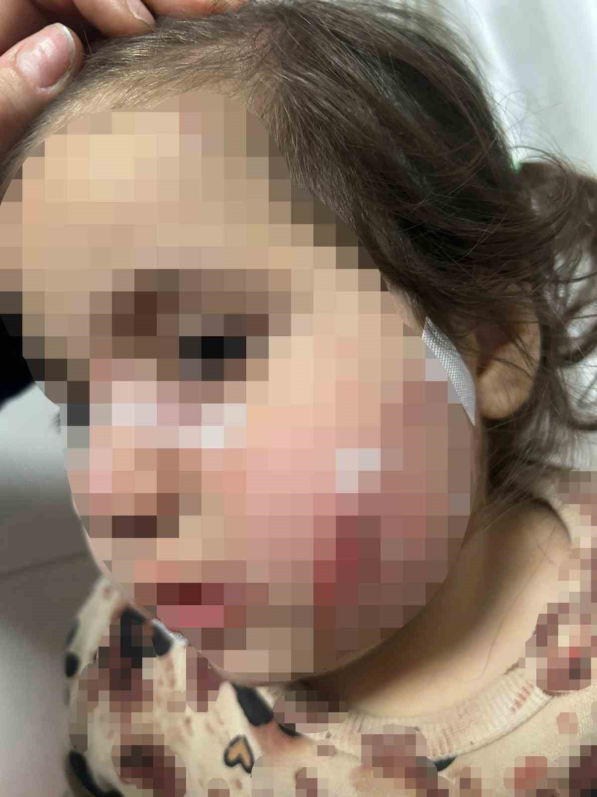 İzmir’de köpek dehşeti: 3 yaşındaki Ada’nın yüzü pençe ve ısırıkla dolu
