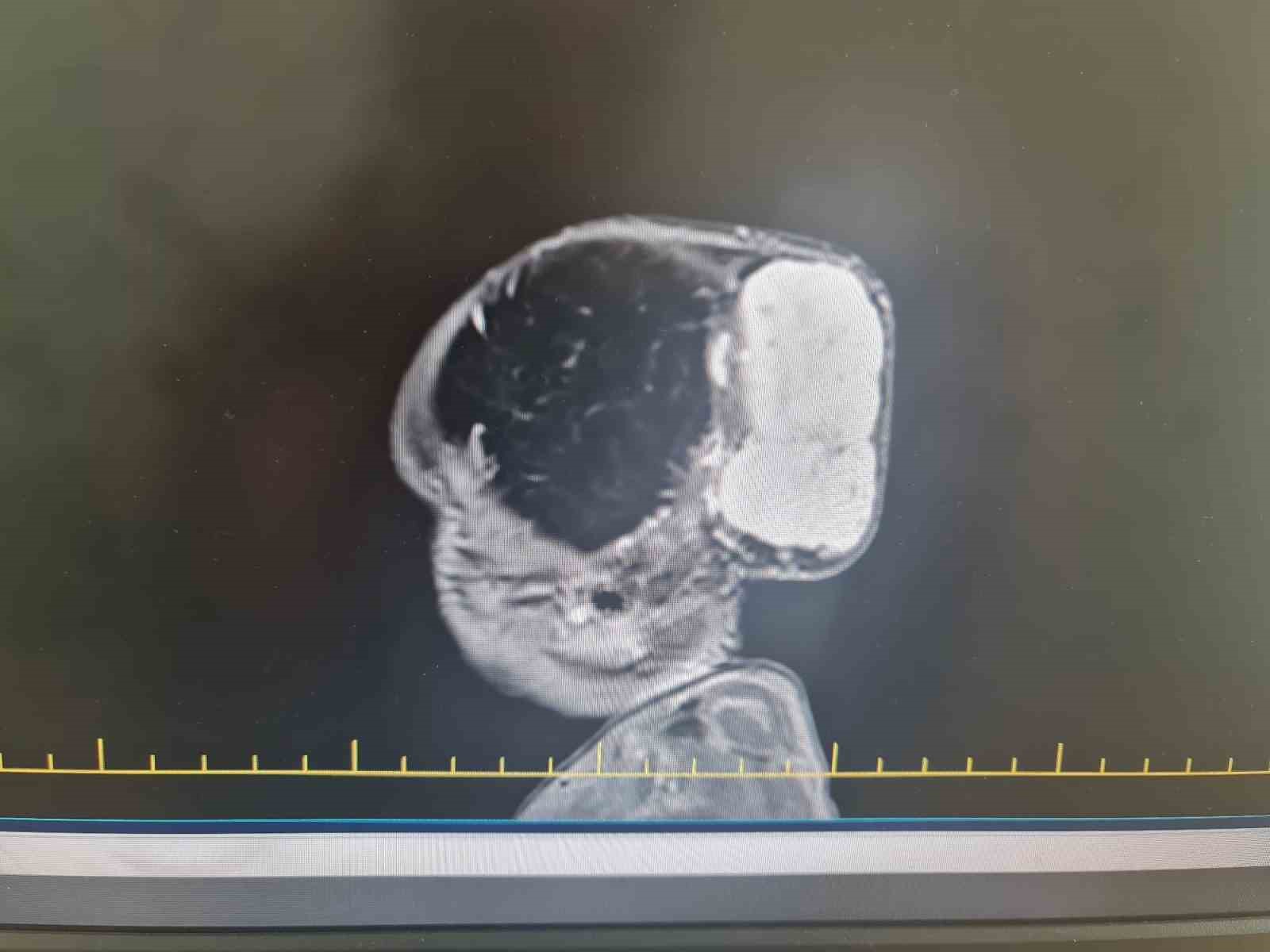 Kafasındaki nadir tümör alındı, hayata tekrar gülümsedi
