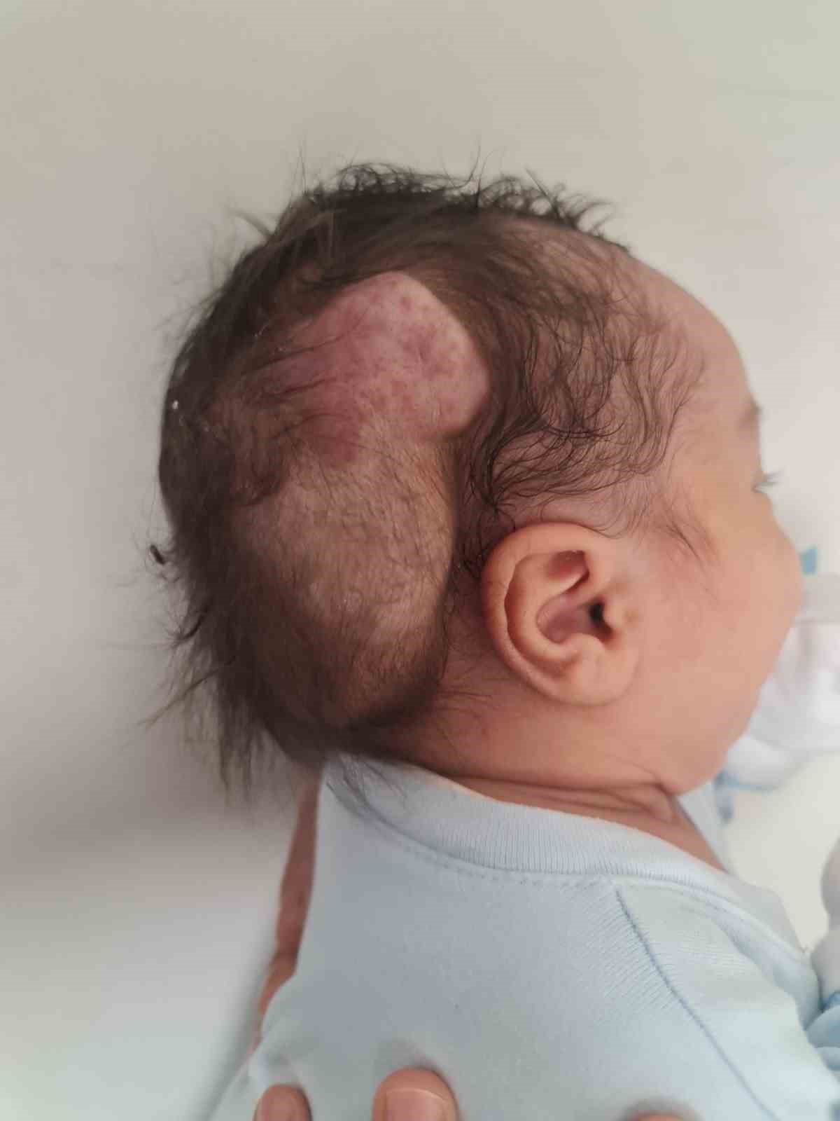 Kafasındaki nadir tümör alındı, hayata tekrar gülümsedi
