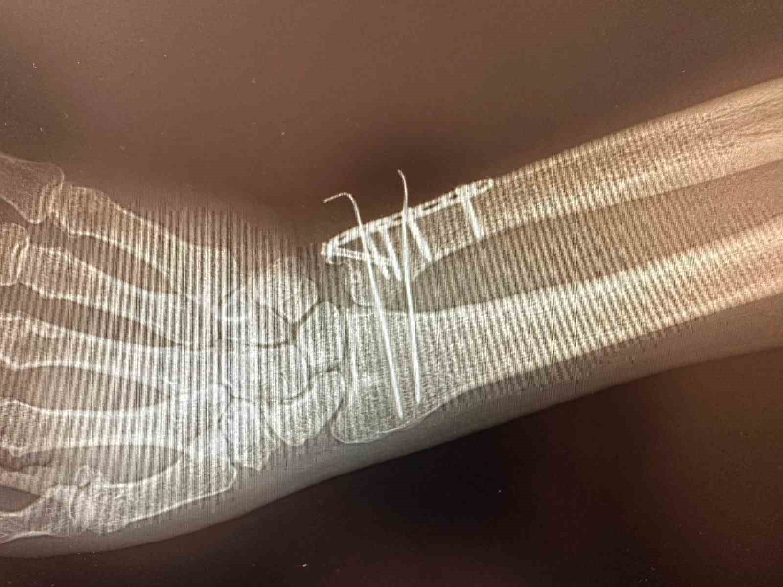 Karakoçan Devlet Hastanesi’nde ortopedi ameliyatları başladı
