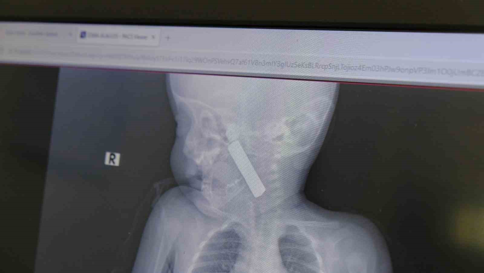 Karaman’da boğazına kumanda pili kalan kaçan bebek ölümden döndü
