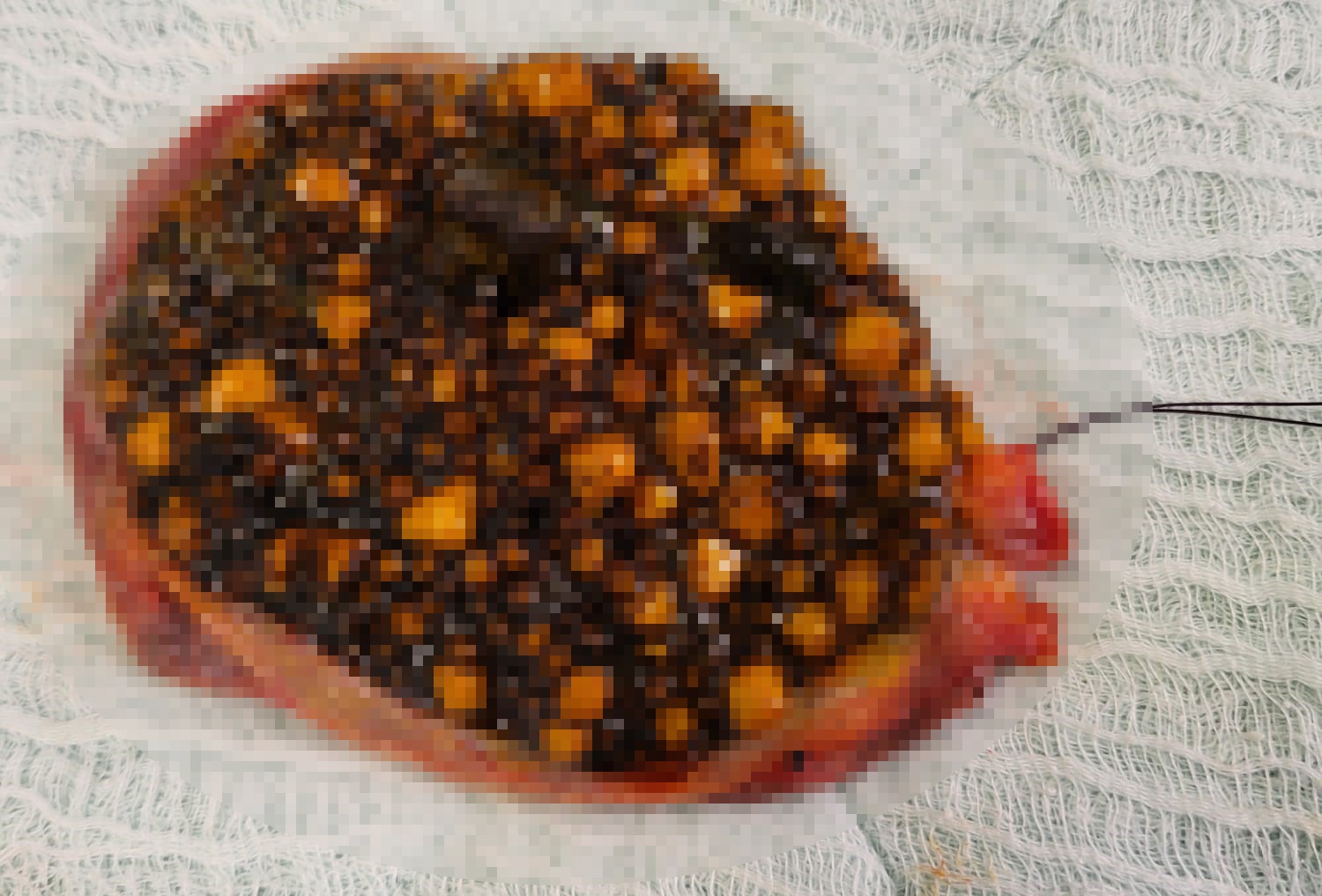 Karın ağrısıyla gitti, safrasından binlerce taş çıktı
