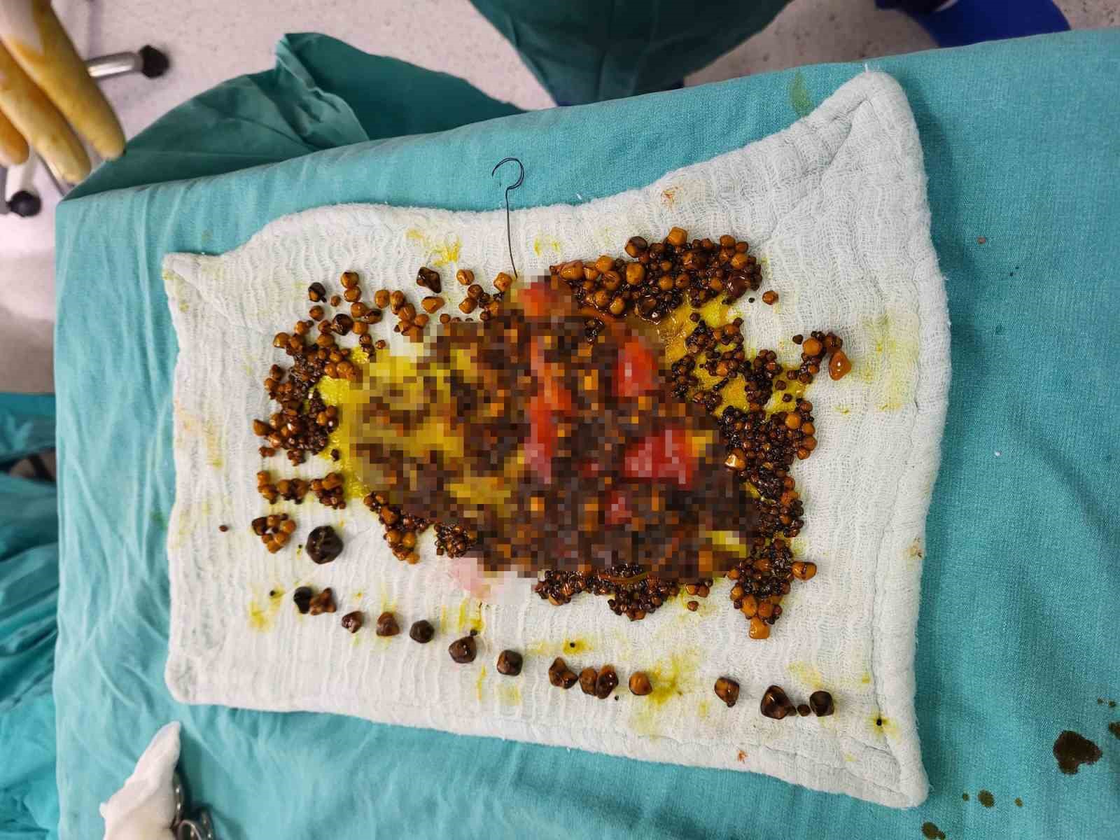 Karın ağrısıyla gitti, safrasından binlerce taş çıktı
