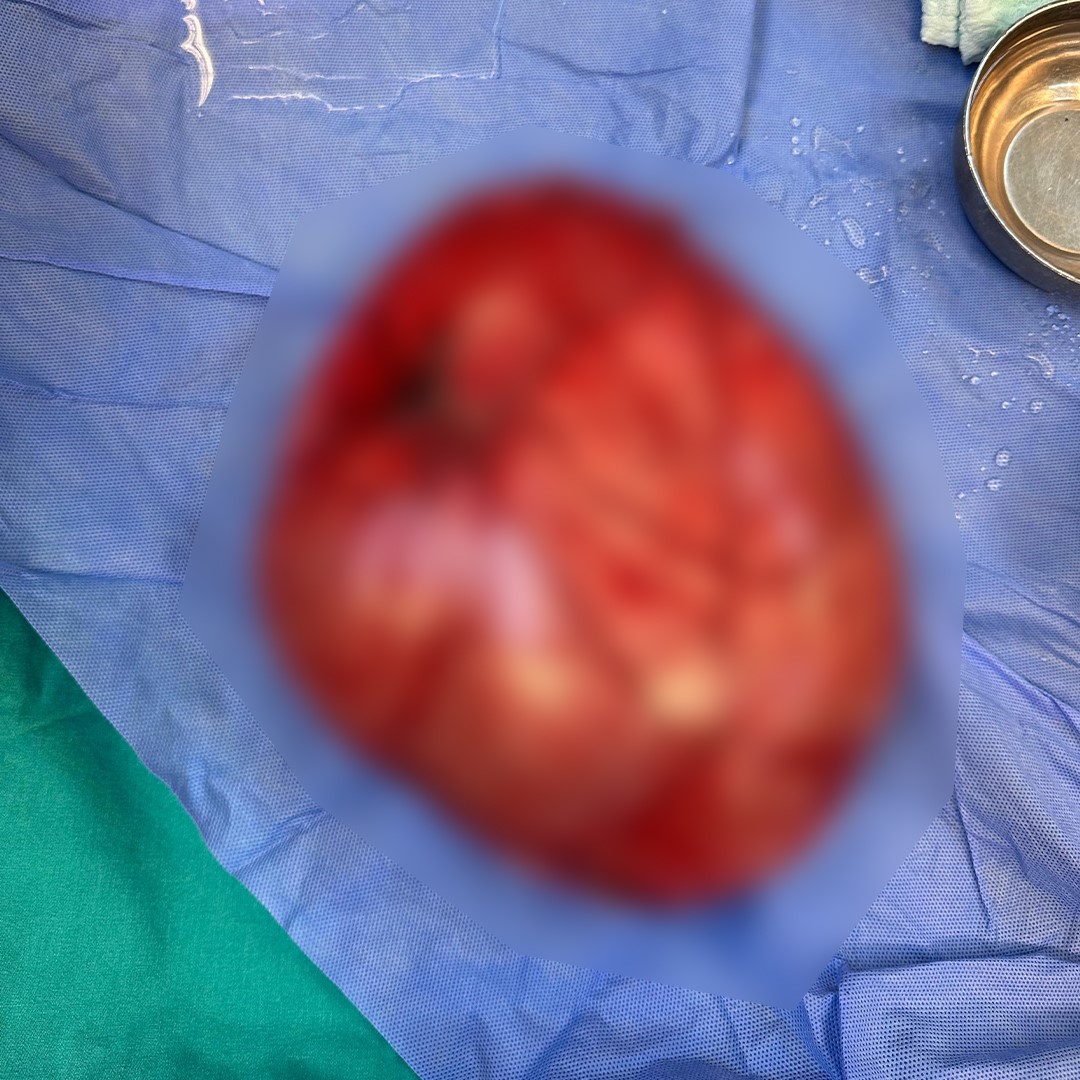 Kilo vermek için hastaneye giden çocuğun karnından 3,5 kiloluk kist çıktı
