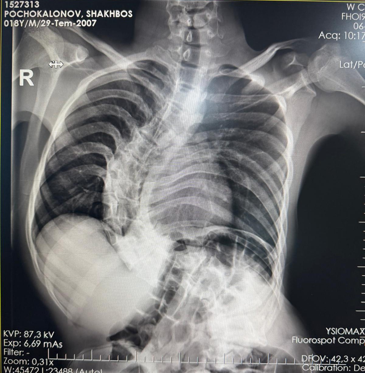 Kırgızistanlı genç şifayı Türk hekimlerinde buldu
