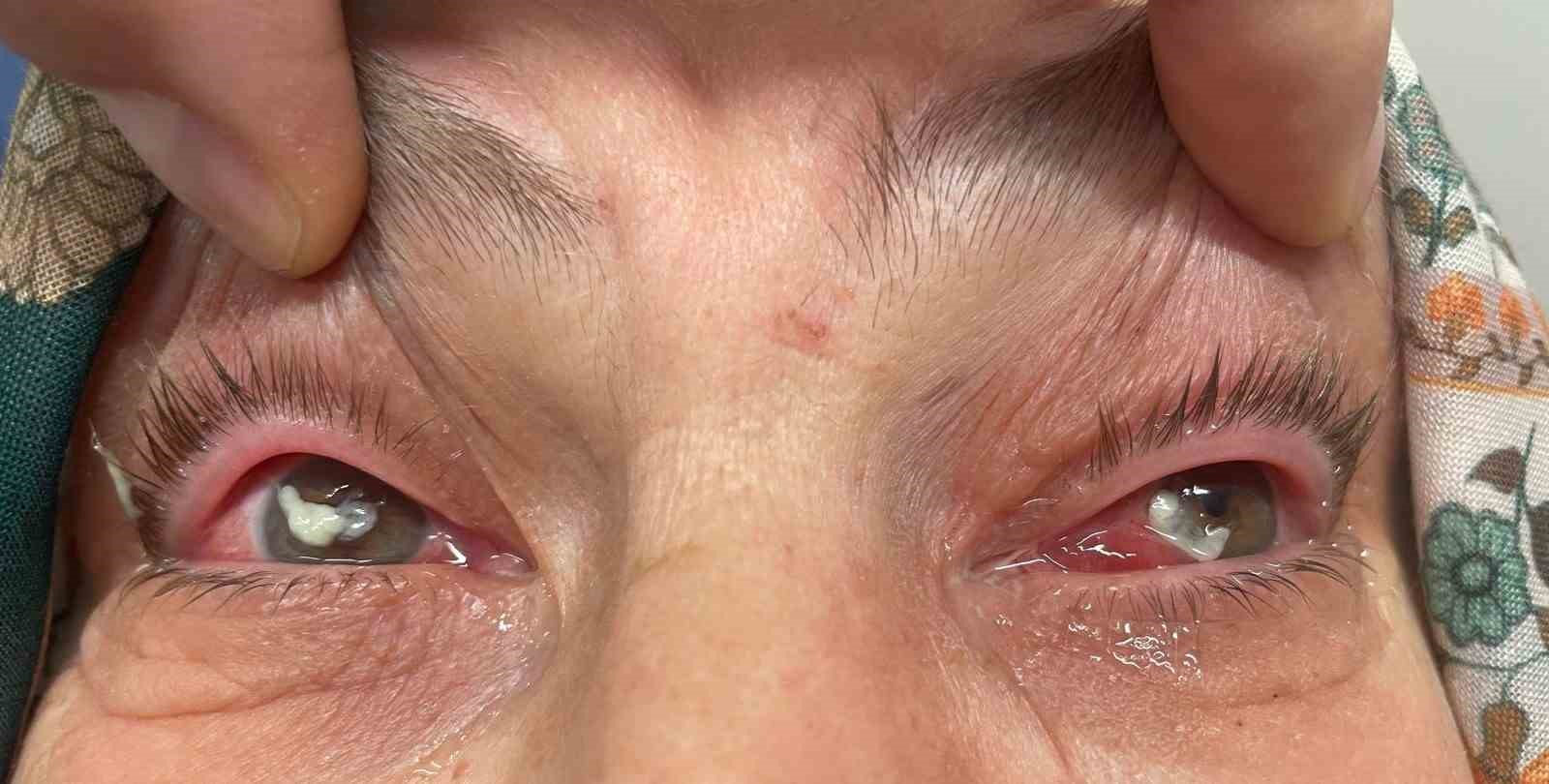 ’Kırlangıç otu kullanımı’na dikkat, uzmanlar uyarıyor: "Gözlerine suyunu damlattı, göremez hale geldi"
’Kırlangıç otu kullanımı’na dikkat, uzmanlar uyarıyor: "Gözlerine suyunu damlattı, göremez hale geldi"