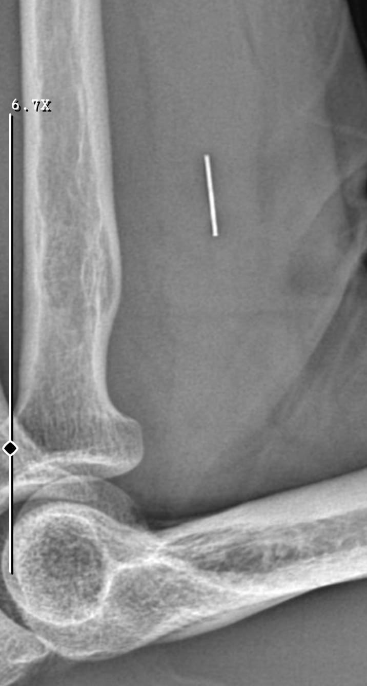 Kurban Bayramı’nda parmağını kesti, başına gelmeyen kalmadı
Kurban Bayramı’nda parmağını kesti, başına gelmeyen kalmadı