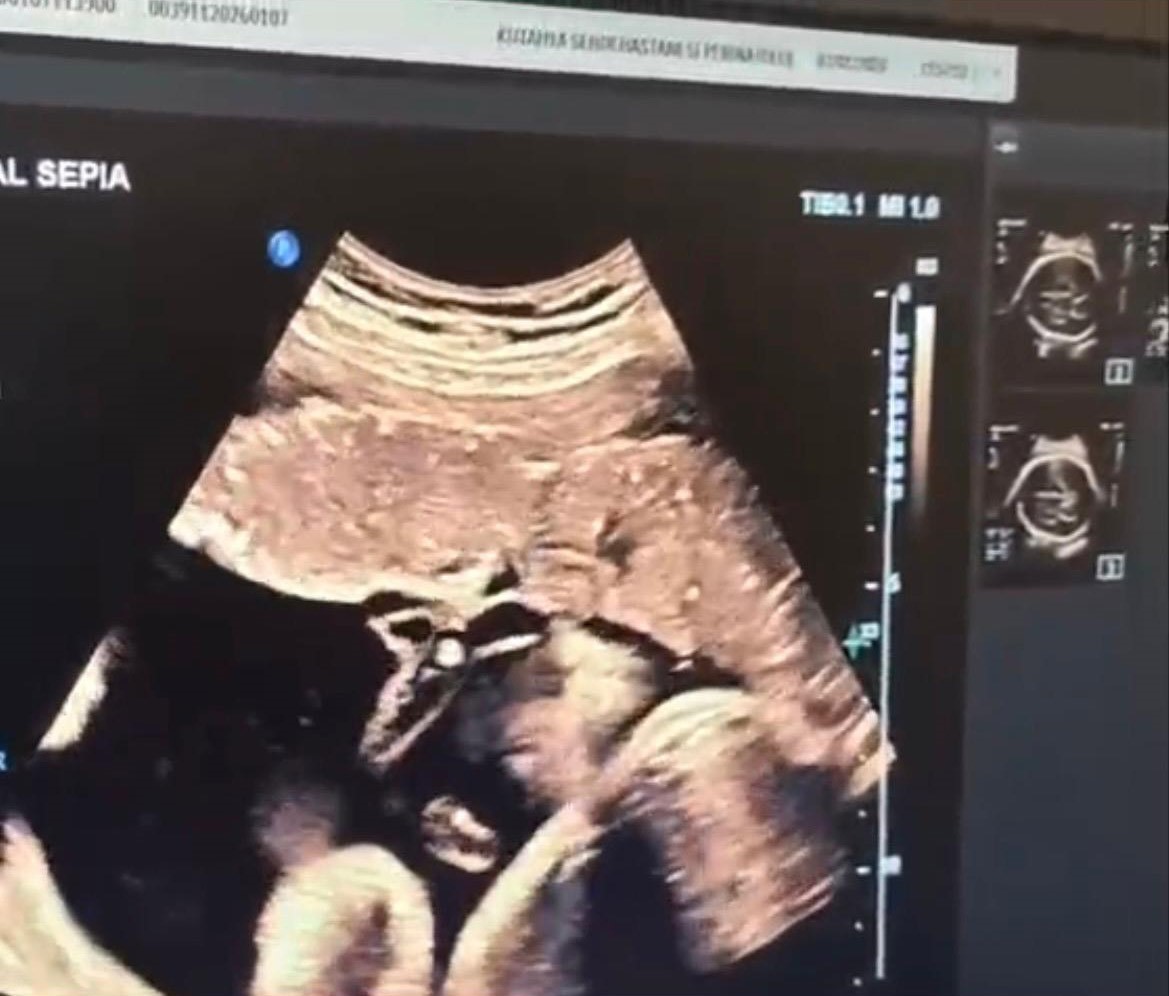 Kütahya Şehir Hastanesi’nde anne karnındaki bebeğe kan nakli yapıldı
