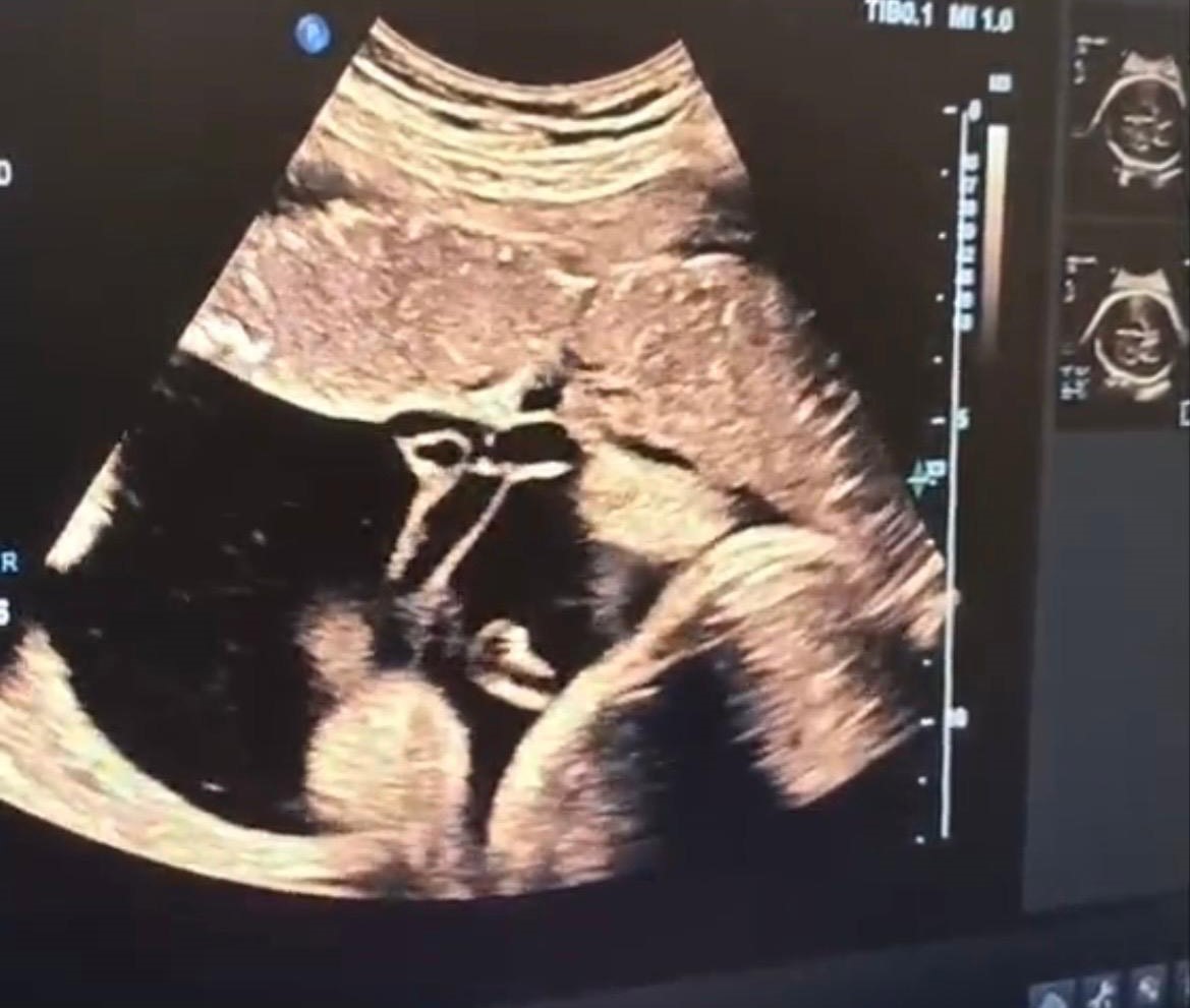 Kütahya Şehir Hastanesi’nde anne karnındaki bebeğe kan nakli yapıldı
